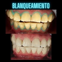 Limpieza dental